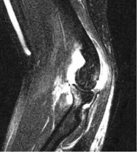 Diagnostic MRI of severe UCL injury--the white appearance reflects edema and swelling from the damage.  The upper arm is at the top of the image; the forearm is at the lower part of the image.